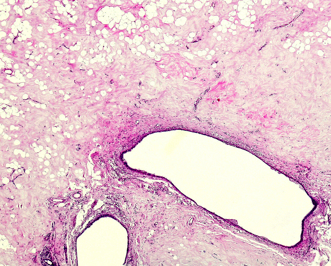 Scar tissue, light micrograph