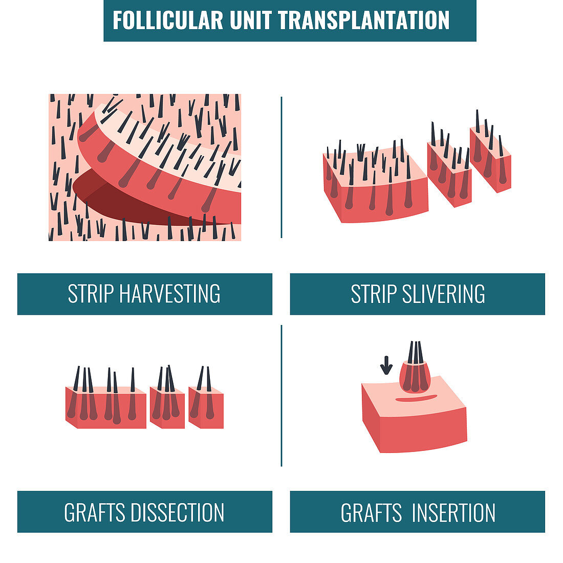 FUT hair transplantation, illustration