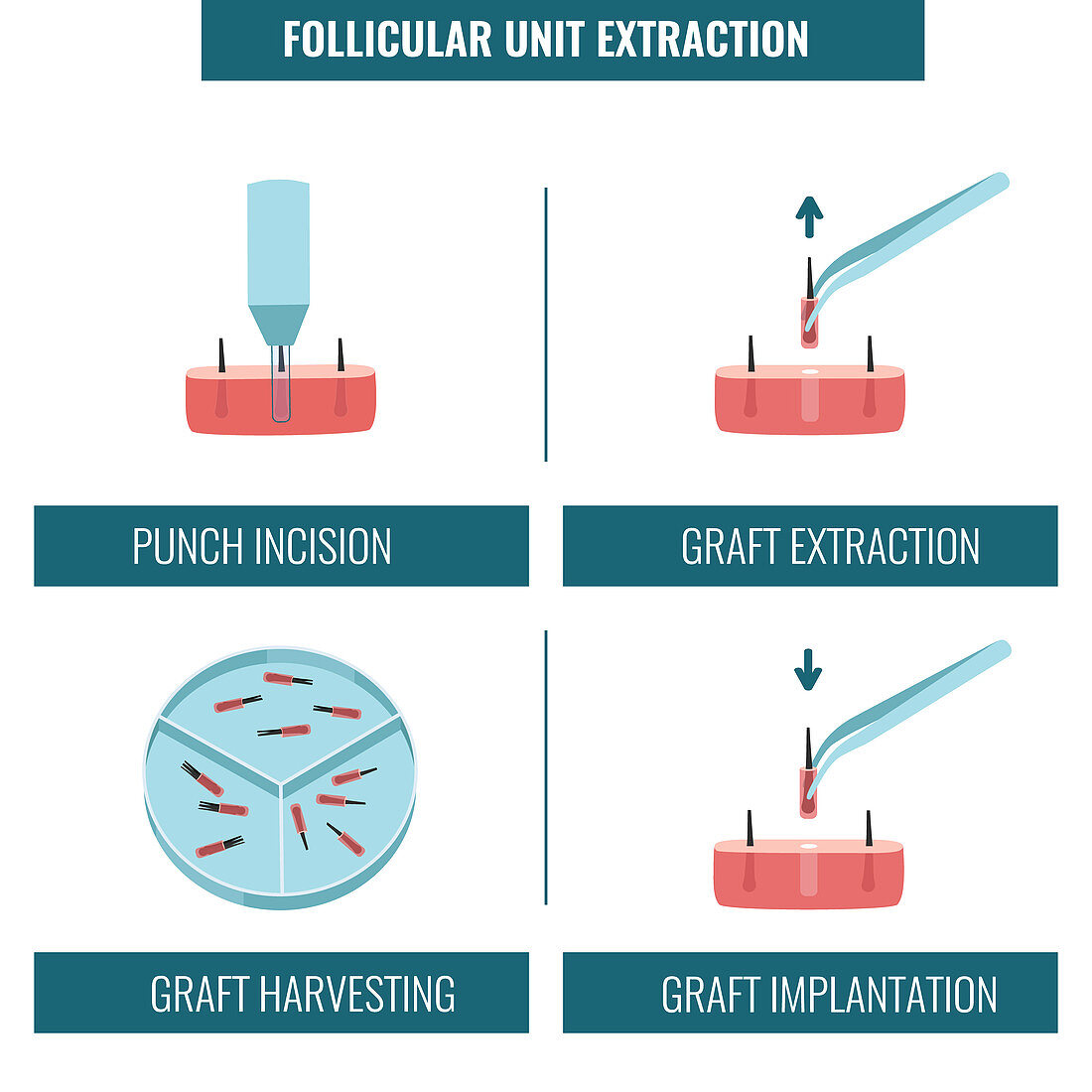 FUE hair transplantation, illustration