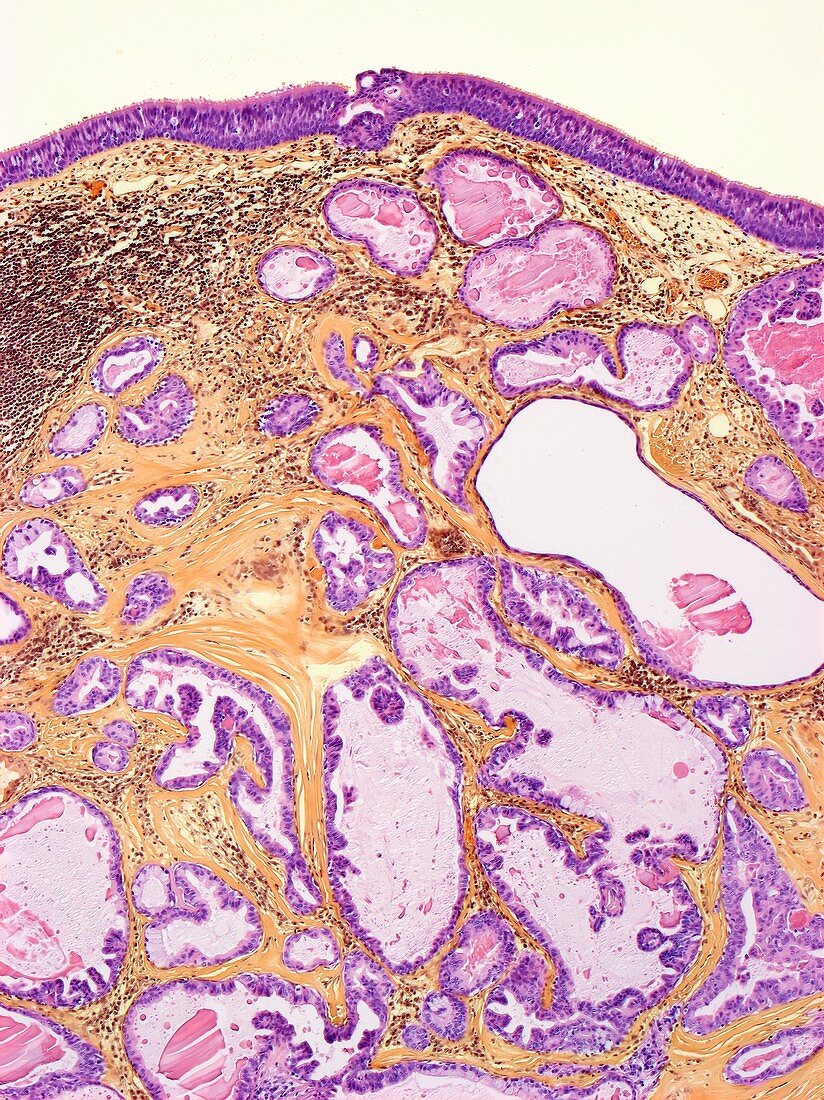 Bronchial adenoma, LM