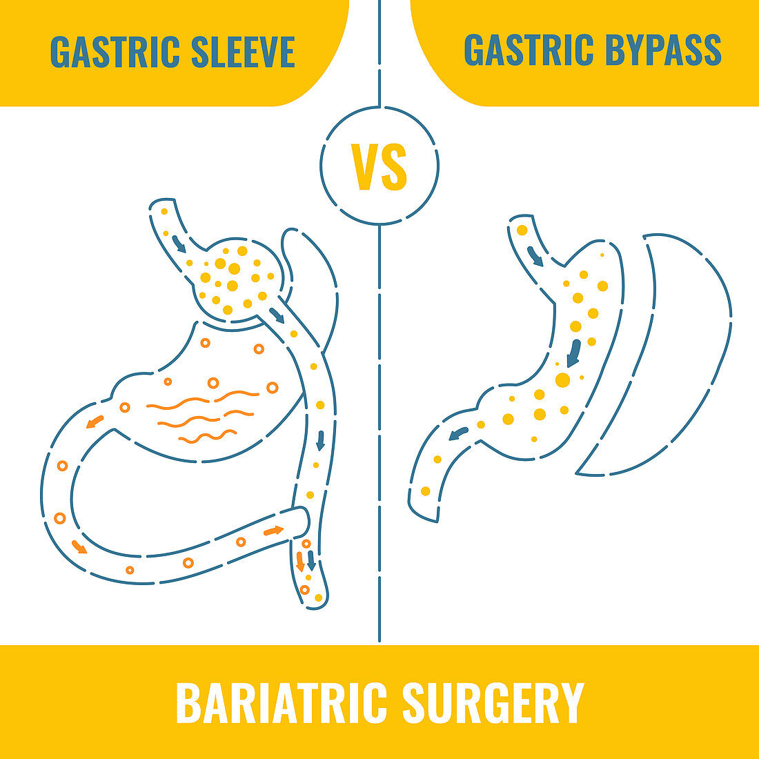 Bariatric surgery, conceptual illustration