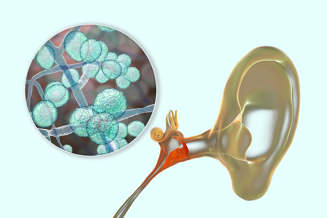 Chronic fungal otitis media ear infection, illustration