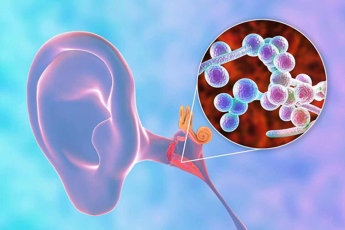 Chronic fungal otitis media ear infection, illustration