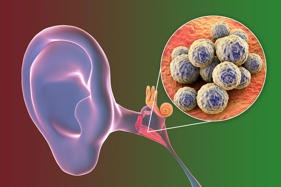 Otitis media ear infection, illustration