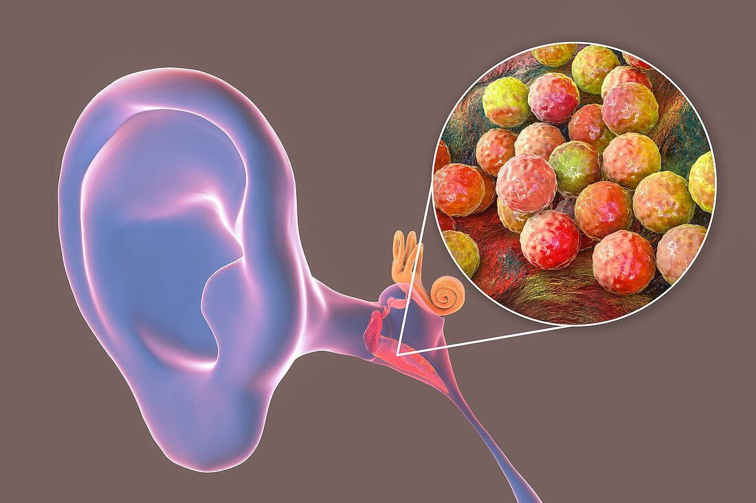 Otitis media ear infection, illustration