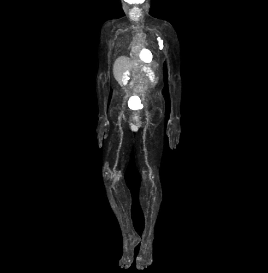 Metastatic melanoma, CT scan