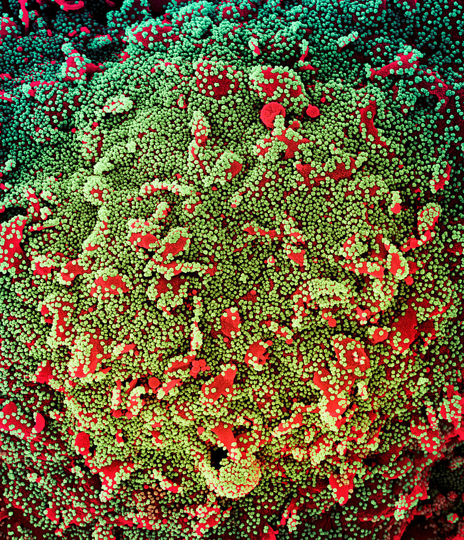 Cell infected by Covid-19 virus particles, SEM