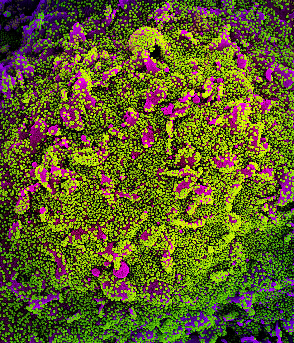Cell infected by Covid-19 virus particles, SEM