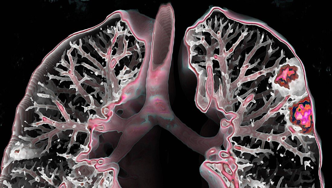 Lungs affected by Covid-19 pneumonia, CT scan