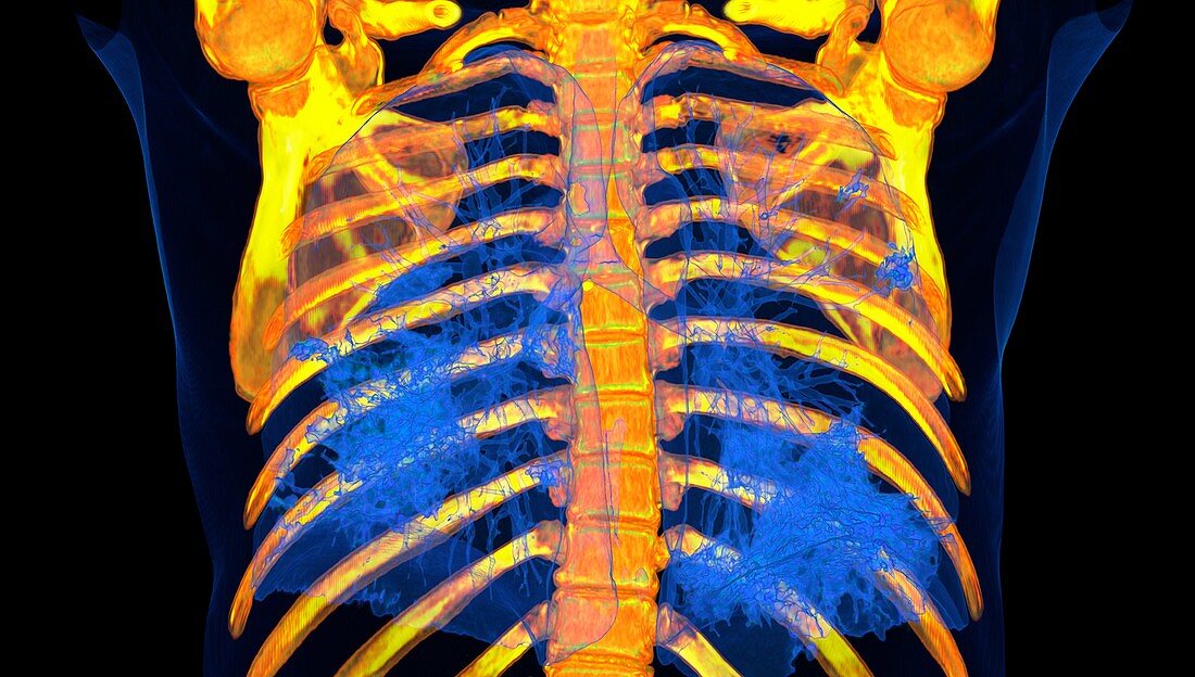 Lungs affected by Covid-19 pneumonia, CT scan