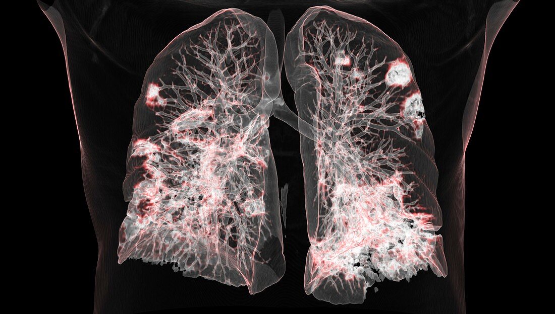 Lungs affected by Covid-19 pneumonia, CT scan