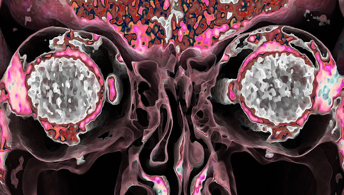 Human eyes, CT scan