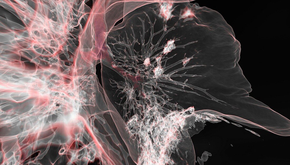 Lung affected by Covid-19 pneumonia, CT scan