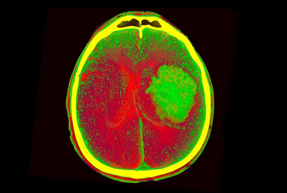 Intraparenchymal haemorrhage, CT scan