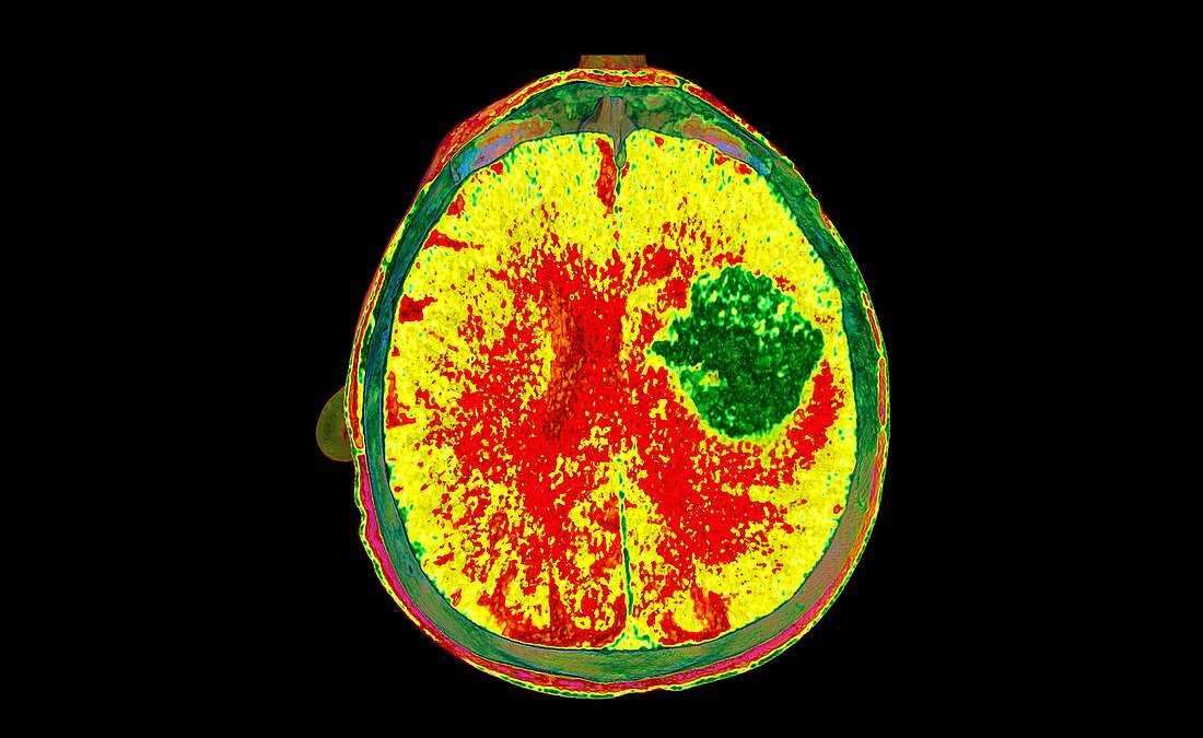 Intraparenchymal haemorrhage, CT scan