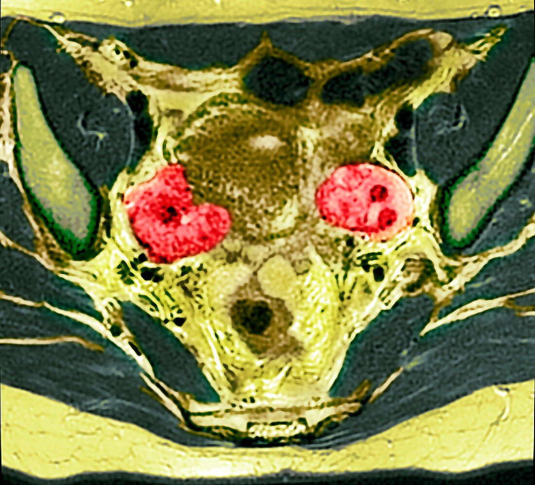 Ovarian cancer, MRI scan