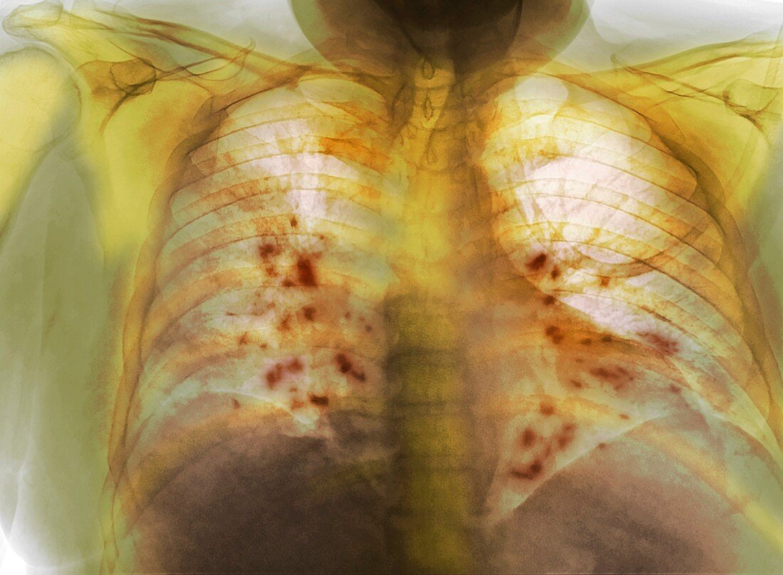 Lungs affected by Covid-19, X-ray