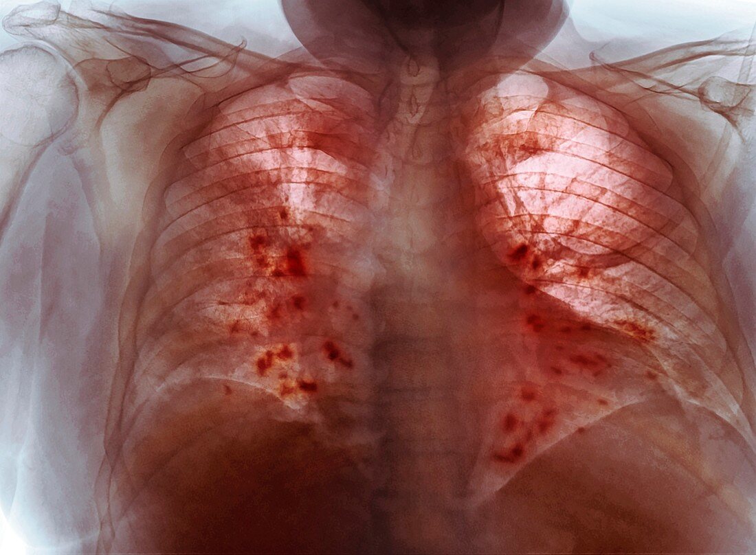 Lungs affected by Covid-19, X-ray