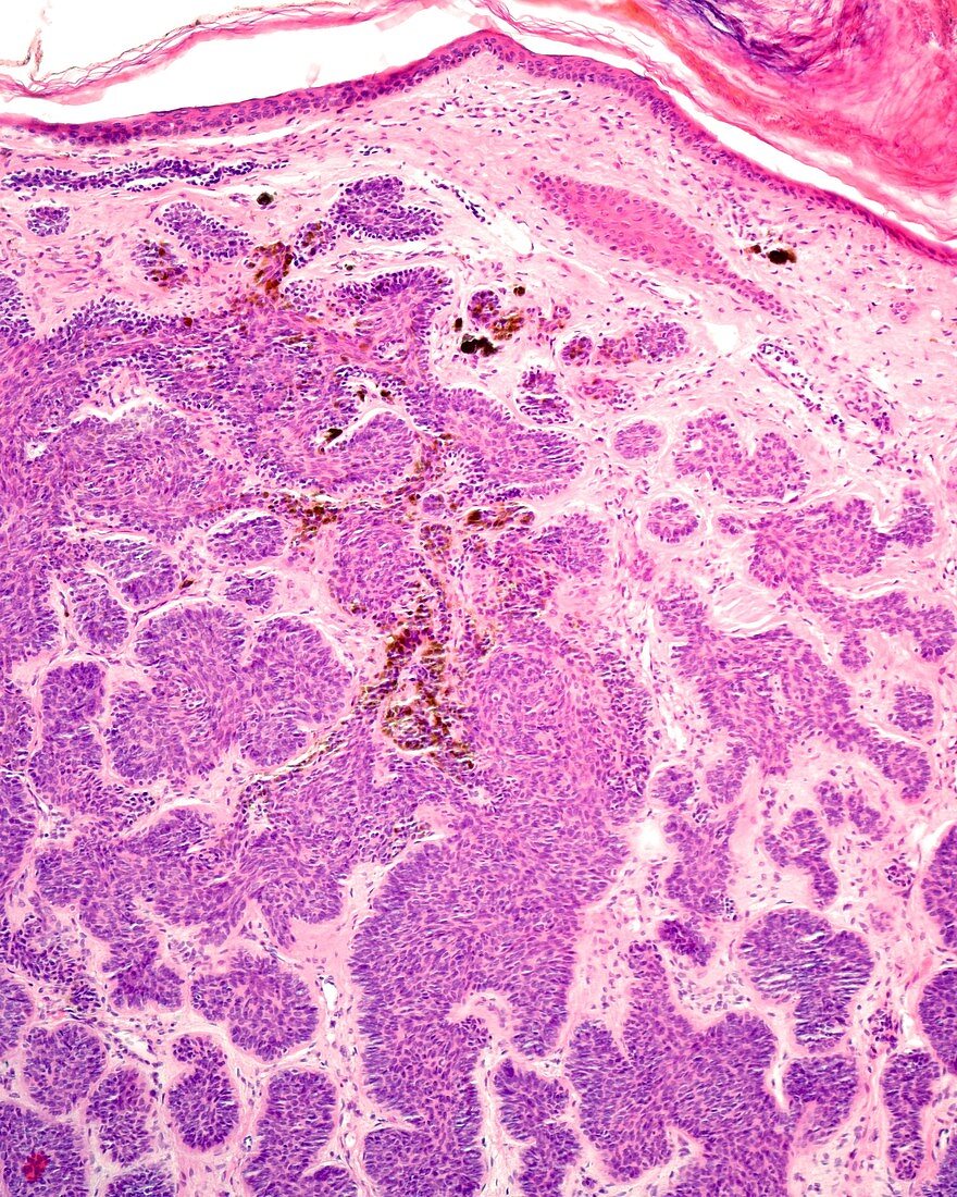 Human basal cell carcinoma, light micrograph