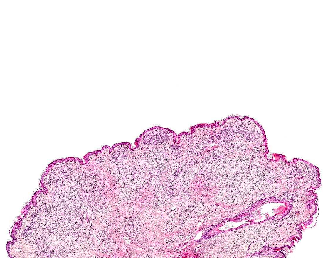 Intradermal nevus, light micrograph