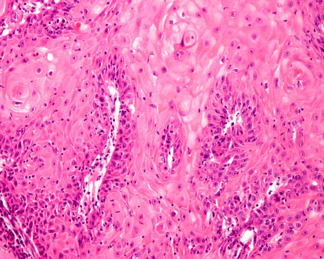 Actinic keratosis, light micrograph