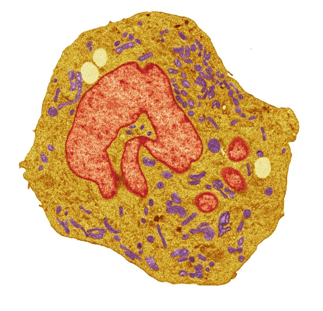 Lymphoma cancer cell, TEM