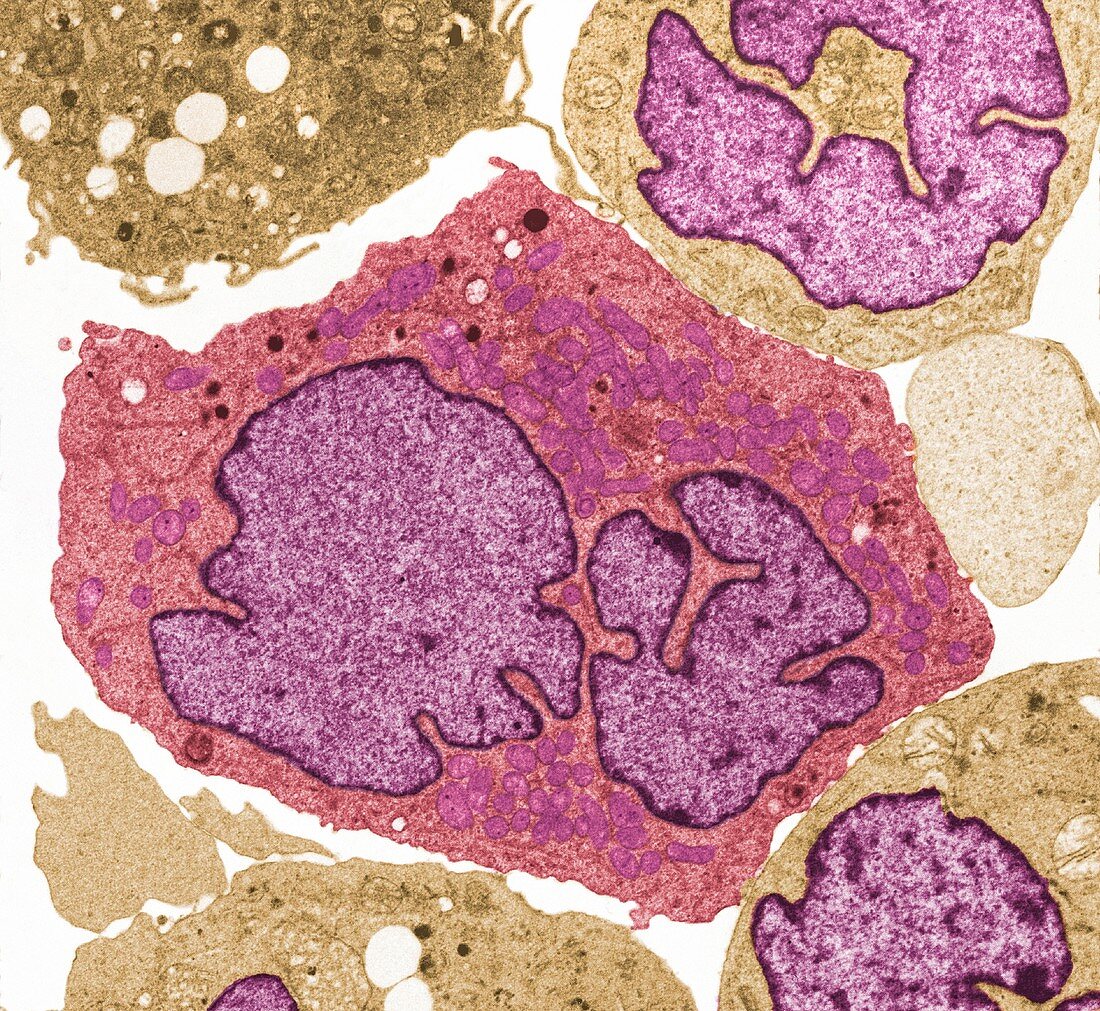 Lymphoma cancer cells, TEM