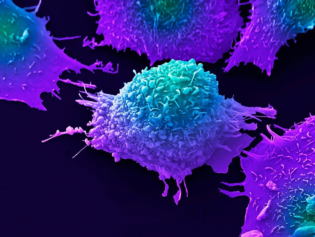 Lung cancer cells, SEM