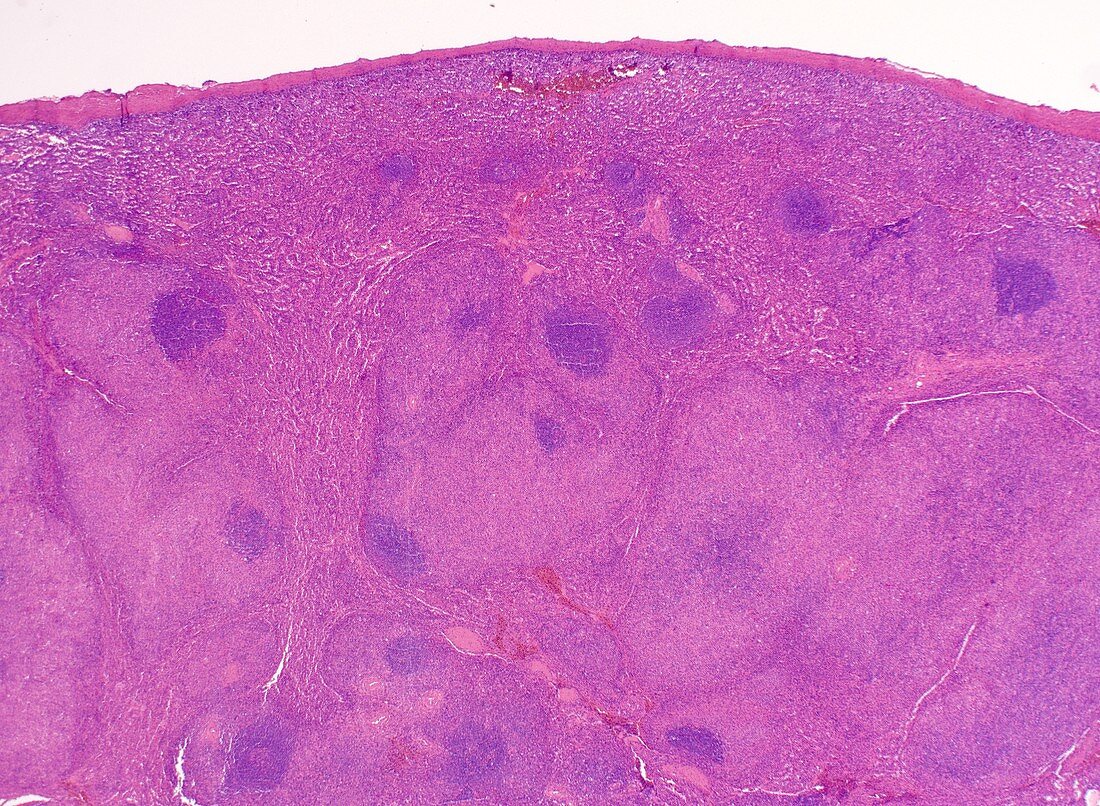 Mixed cellularity Hodgkin lymphoma, light micrograph