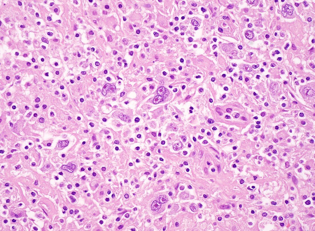 Nodular sclerosis Hodgkin lymphoma, light micrograph