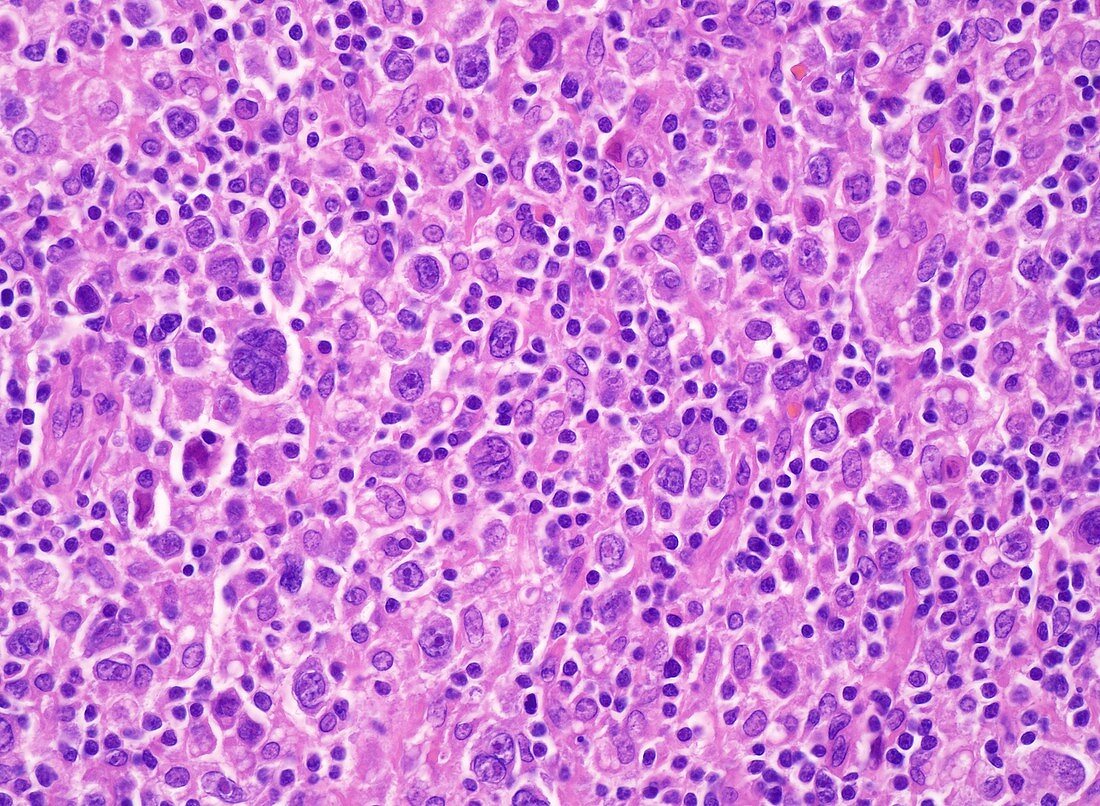 Nodular sclerosis Hodgkin lymphoma, light micrograph