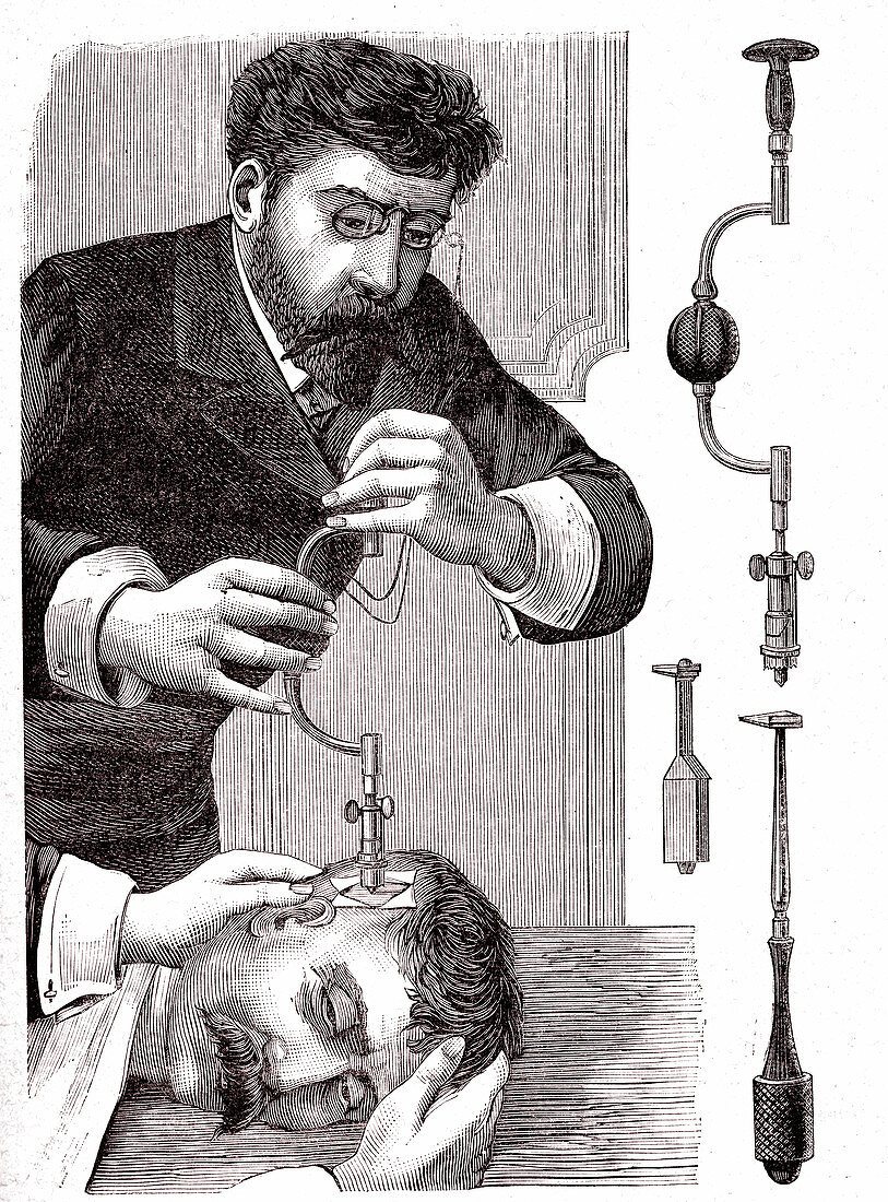 19th Century trepanning treatment, illustration