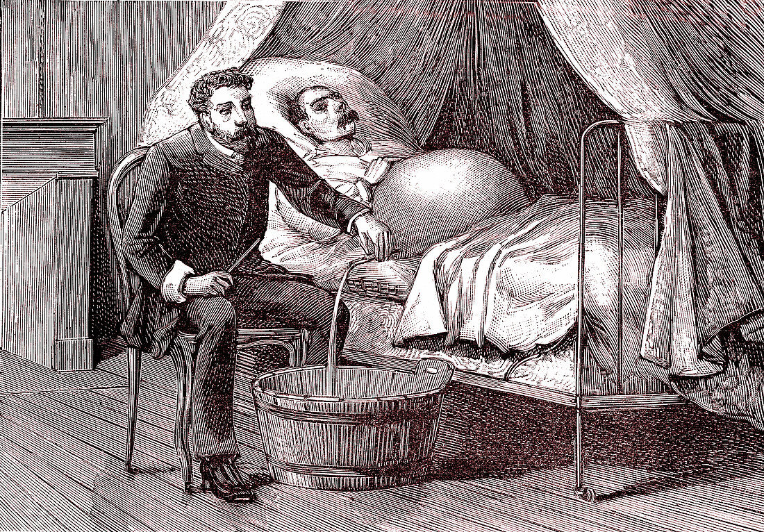 19th Century cirrhosis treatment, illustration