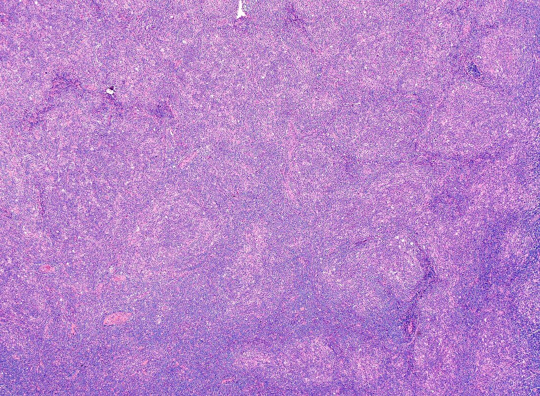 Nodular lymphocyte-predominant Hodgkin lymphoma, micrograph