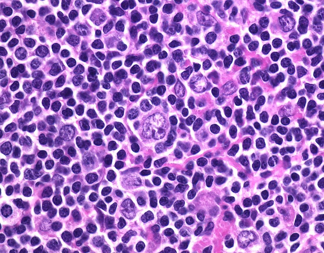 Nodular lymphocyte-predominant Hodgkin lymphoma, micrograph