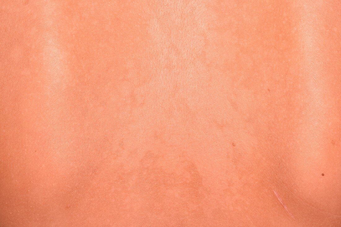 Pityriasis versicolor