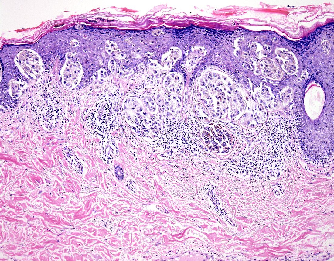 Melanoma depth of invasion, light micrograph