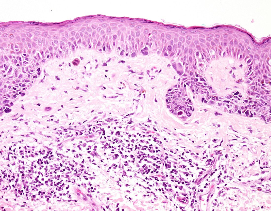 Lentigo maligna melanoma, light micrograph