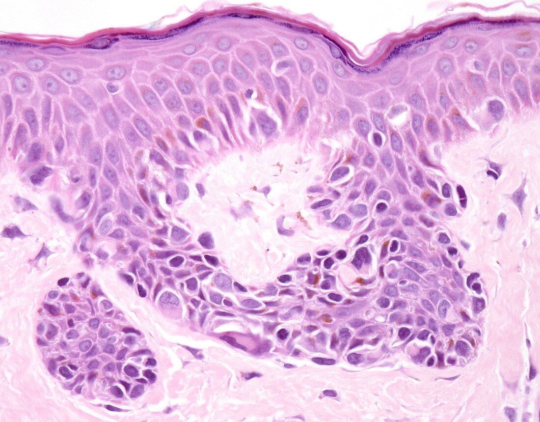 Lentigo maligna melanoma, light micrograph