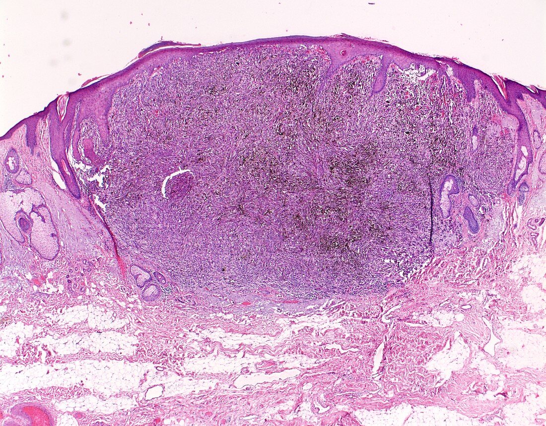 Nodular melanoma, light micrograph