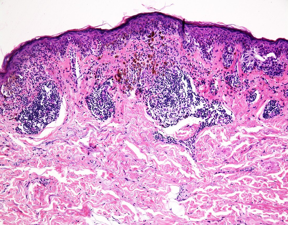 Melanoma with partial regression, light micrograph