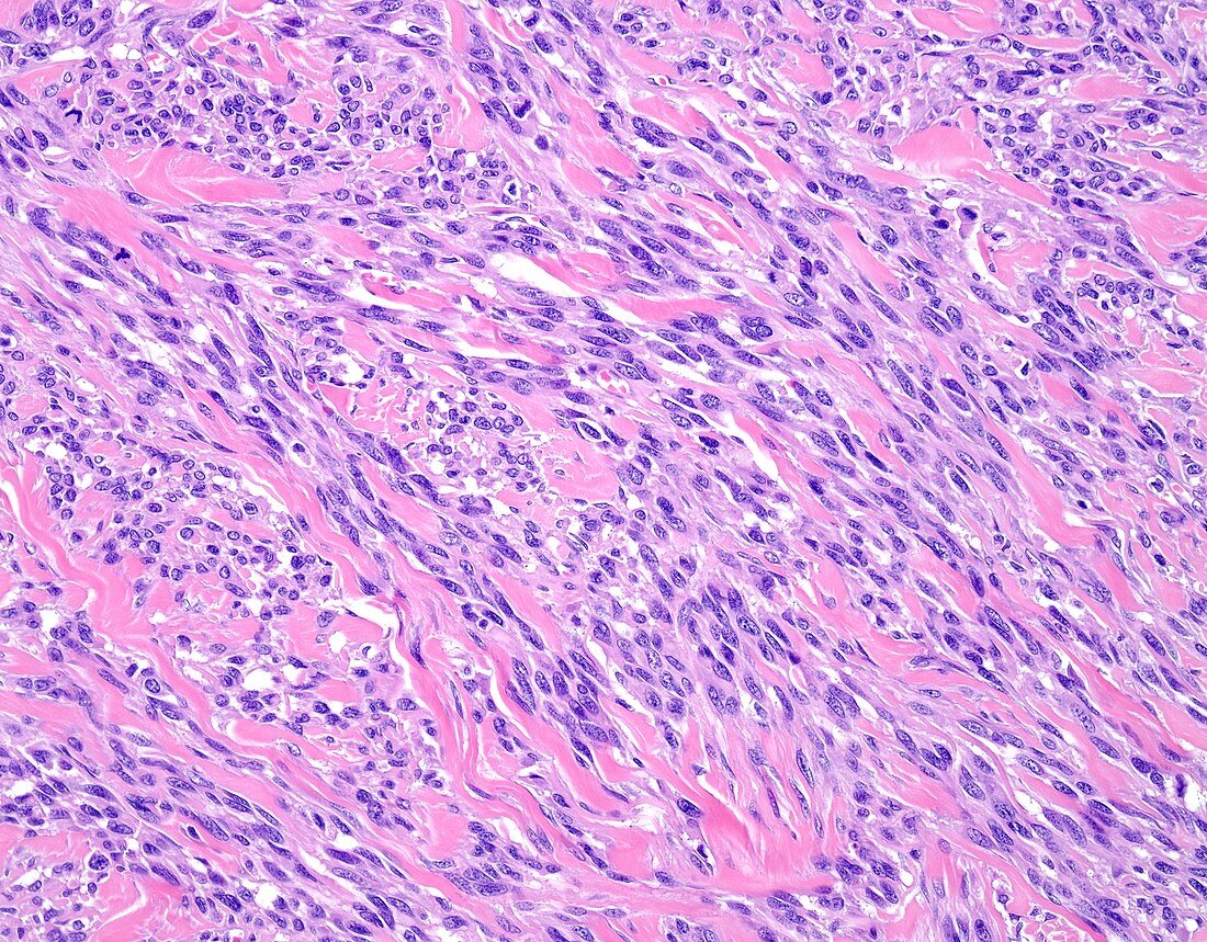 Spindle cell melanoma, light micrograph