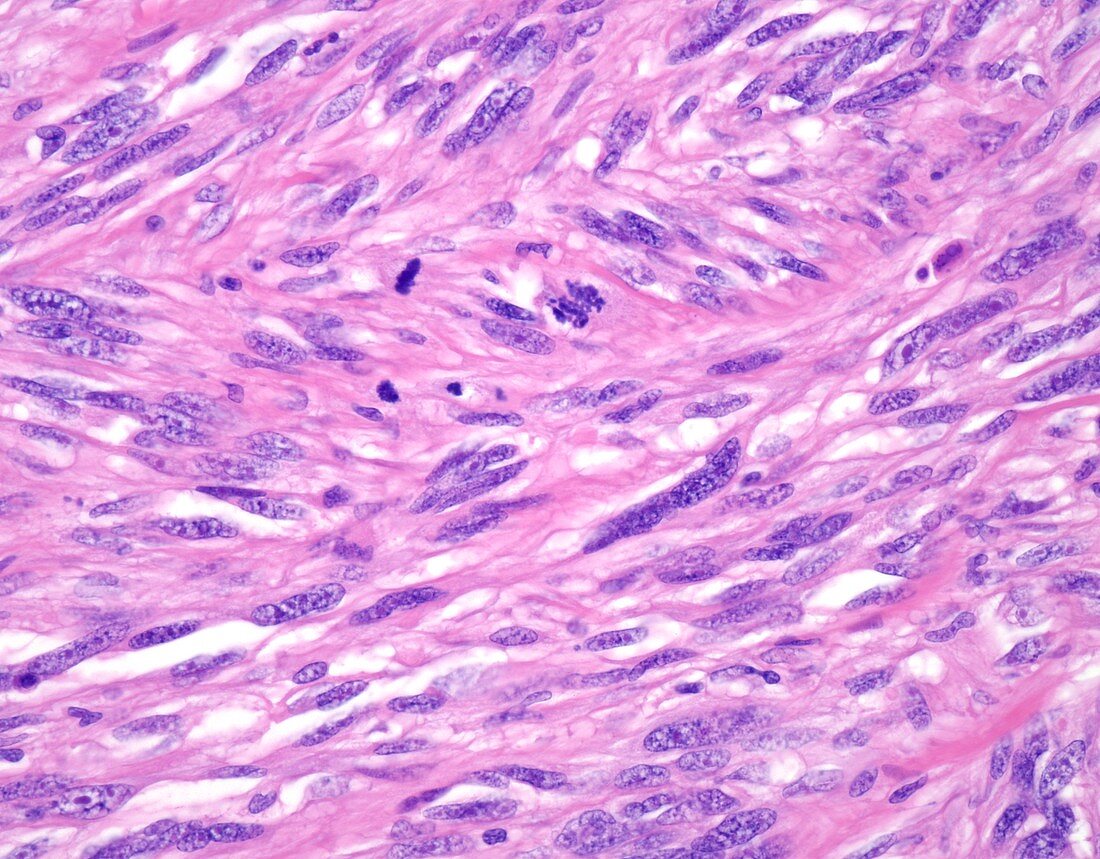 Spindle cell melanoma, light micrograph