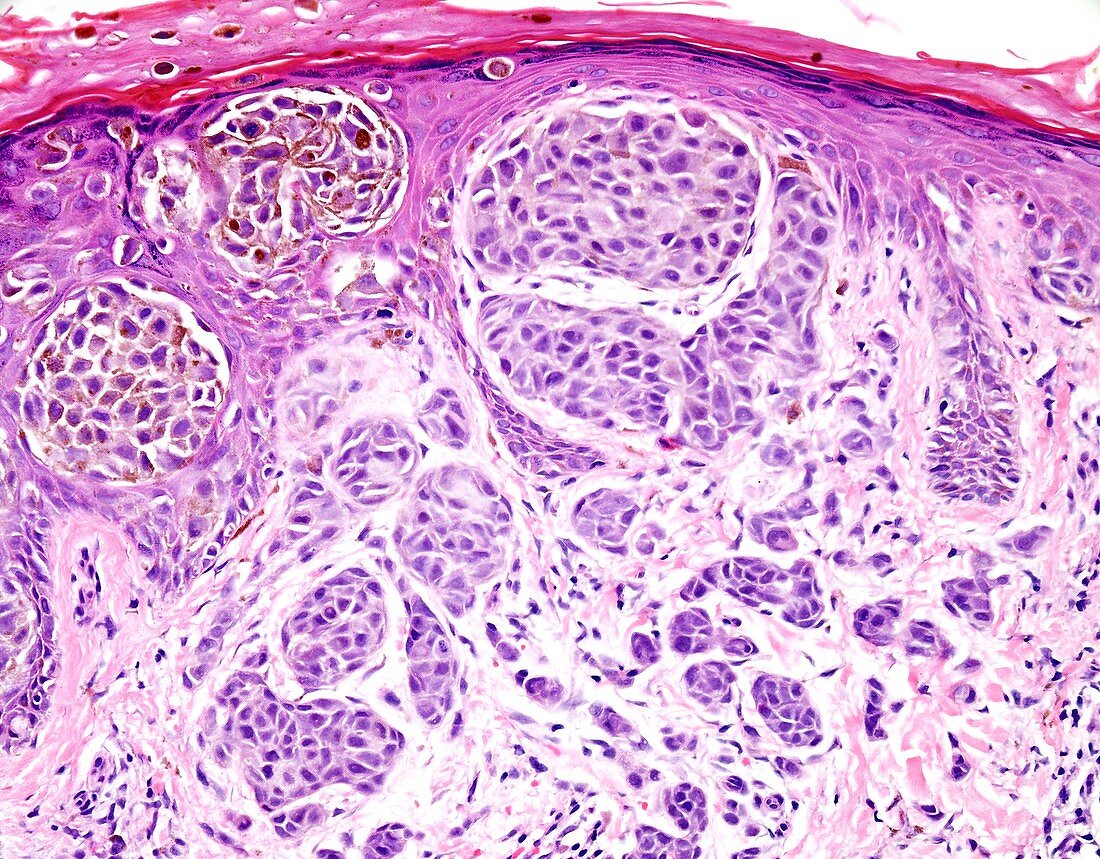 Superficial spreading melanoma, light micrograph