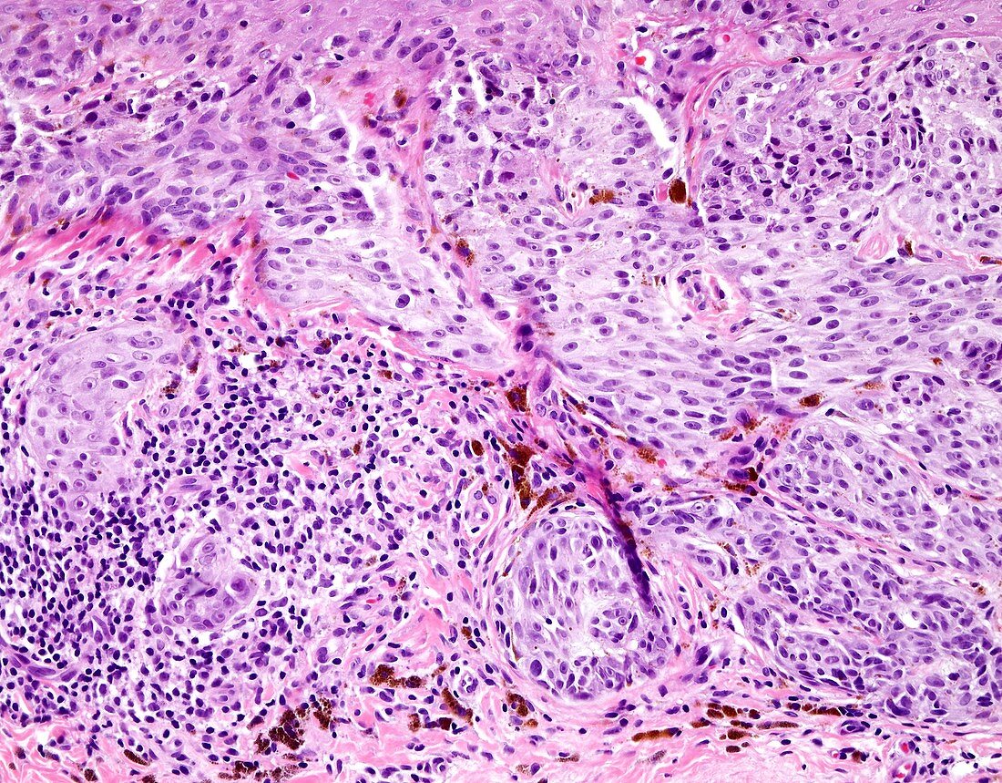 Melanoma tumor infiltrating lymphocytes, light micrograph