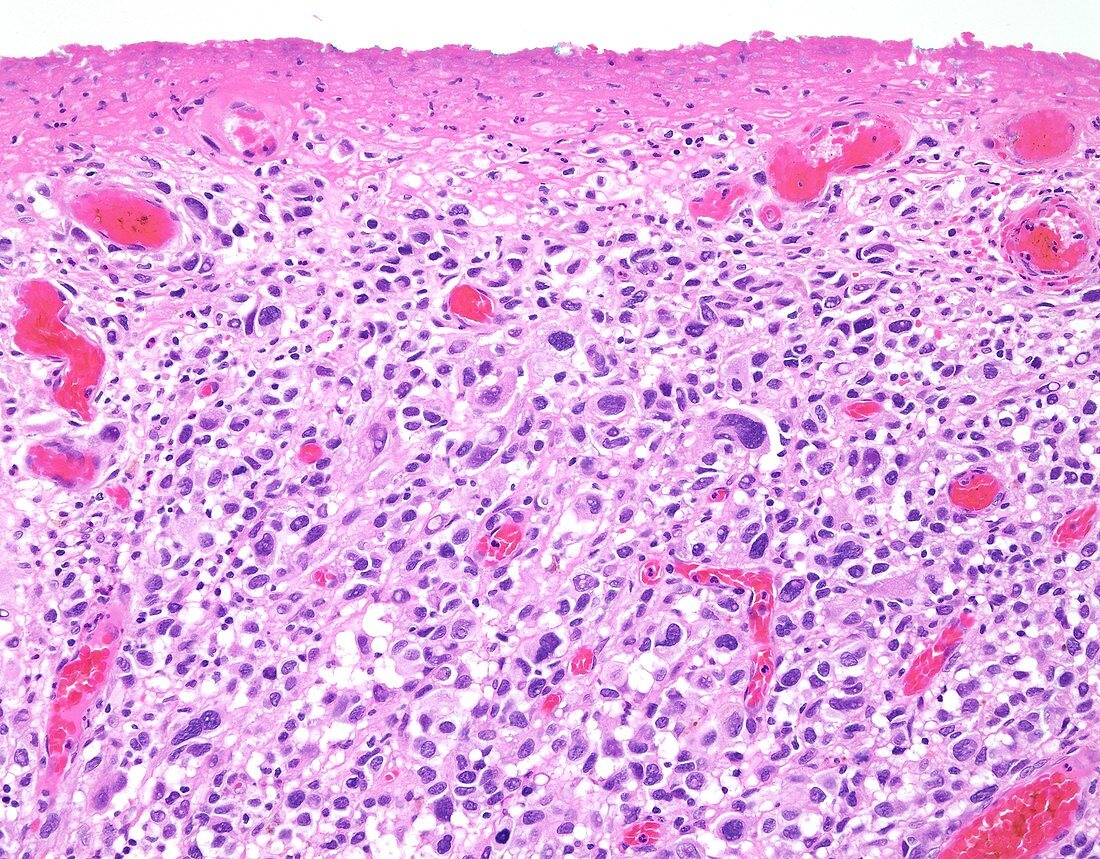 Melanoma with ulceration, light micrograph