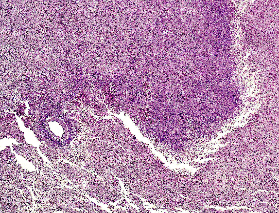 Neuro astrocytoma, light micrograph