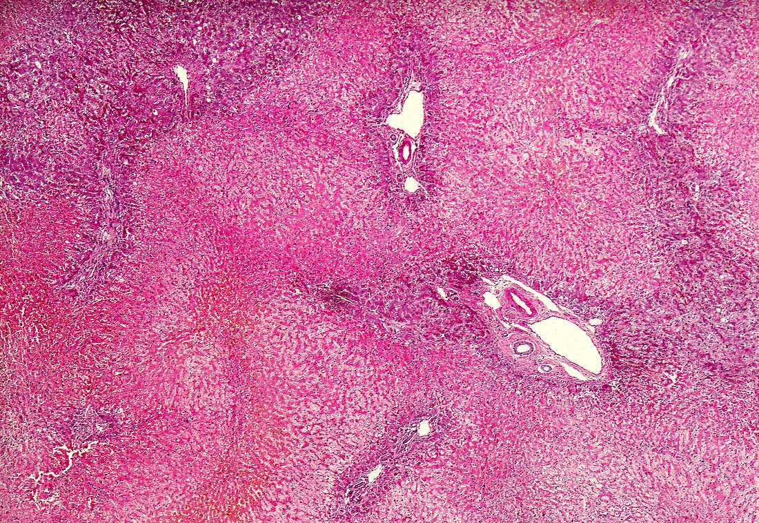 Chronic hepatic congestion of the liver, light micrograph