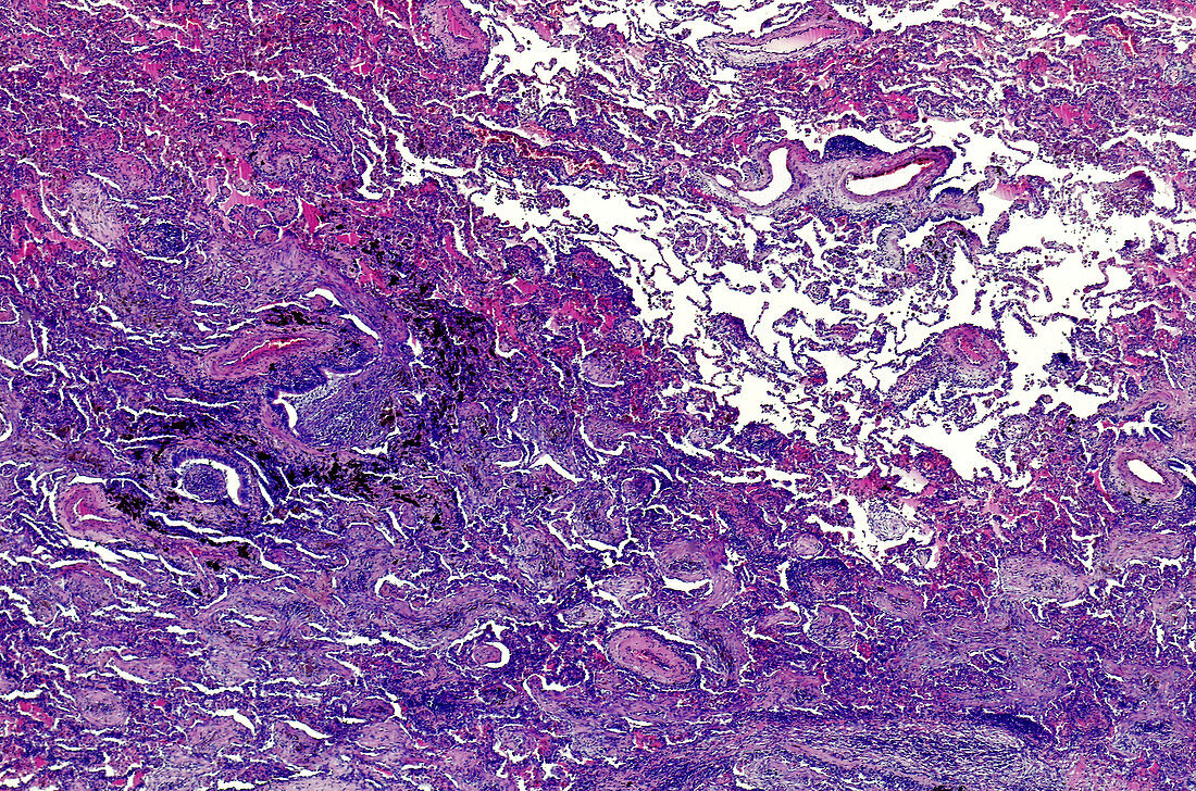 Cystic fibrosis, light micrograph