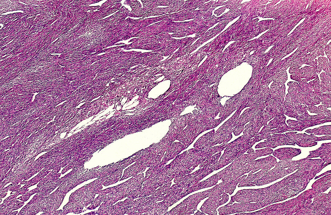 Giant cell tumour of the bone, light micrograph